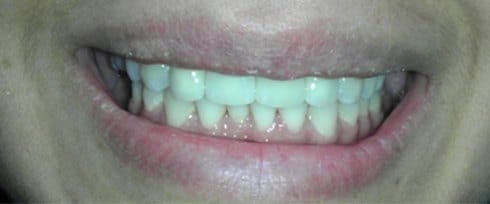 Bright healthy smile after dental care