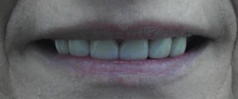 Evenly spaced teeth