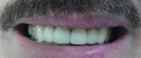 Smile with natural looking new dental restoration