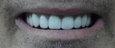 Top teeth fully restored