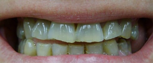 Worn and damaged smile before treatment