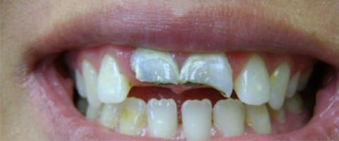 Front top two teeth with severe decay and damage
