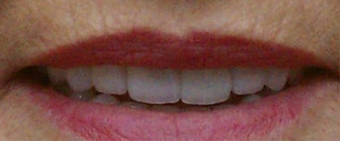 White and healthy smile after cosmetic dentistry