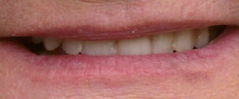 Yellowed smile before teeth whitening