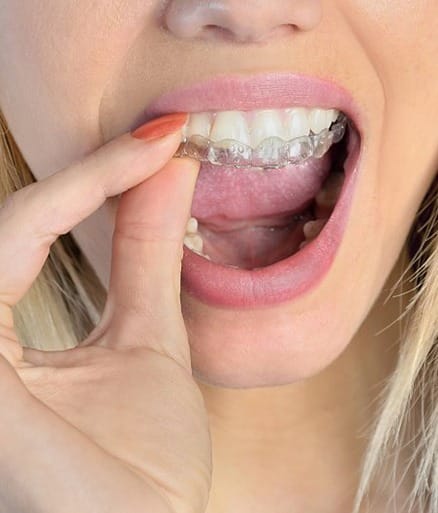 Closeup of patient placing an Invisalign tray