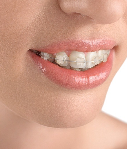 Closeup of smile with tooth colored braces