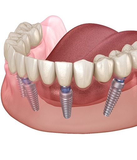 Animated smile with all on four dental implants