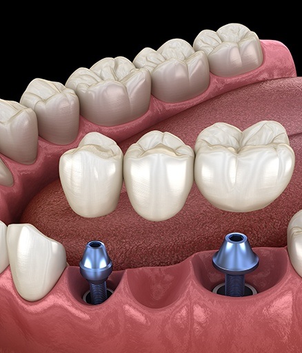 Animated smile during dental implant supported dental bridge placement