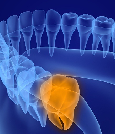 3 D digital image of smile in need of wisdom tooth extraction