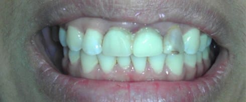 Top teeth with discoloration at gum line