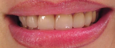 Chipped front teeth repaired after dental care