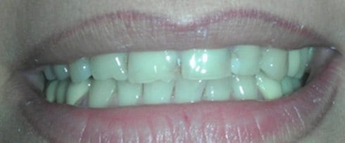 Chipped top front teeth before dental care
