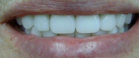 Brite perfectly aligned smile after treatment