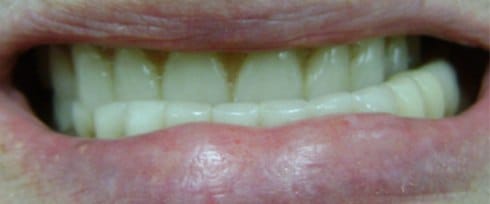Discolored smile with underbite before treatment
