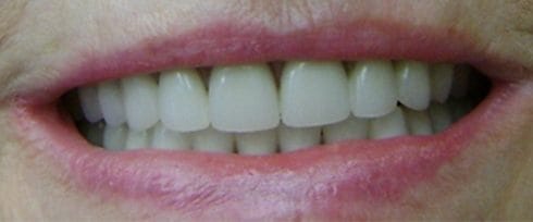 Healthy bright smile after dental care