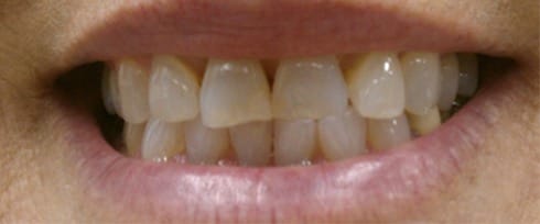 Yellowed and worn teeth before cosmetic dentistry