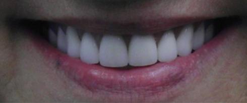 Perfect smile after alignment and cosmetic dentistry