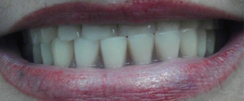Smile with cross bite and dental discoloration