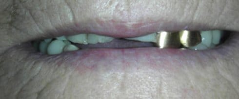 Damaged front teeth and gold dental crown