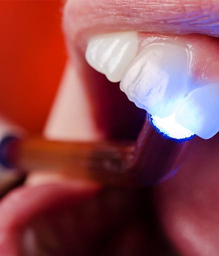 Closeup of smile during dental sealant placement