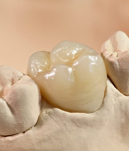 Model smile with all ceramic dental crown