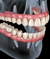 Aniamted smile with dental implant supported dentures