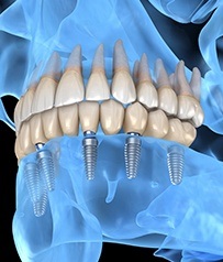 3 D rendering comparing natural teeth to the dental implant retained dentures