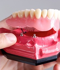 Model of removable dental implant denture