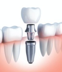 Animated dental implant supported dental crown being placed