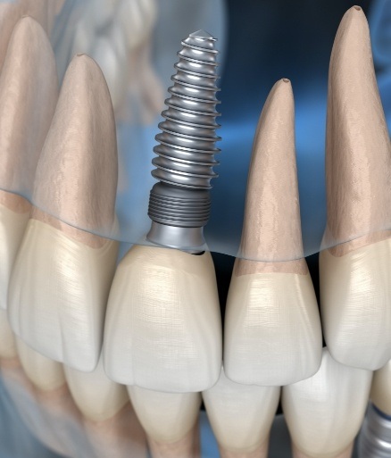 3 D rendering of smile with dental implant supported replacement teeth