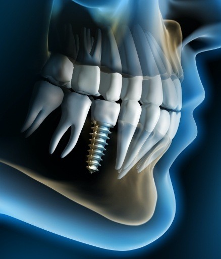 3 D rendering of jaw and skull with dental implant supported replacement tooth