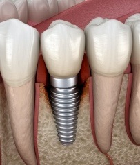 Animated smile with dental implant supported replacement tooth in grafted bone tissue