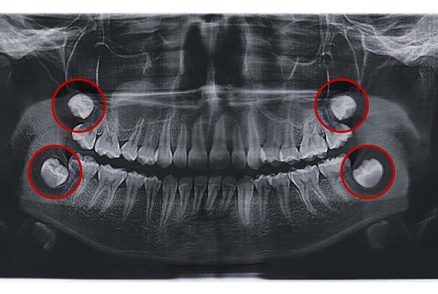 X-ray with the wisdom teeth highlighted