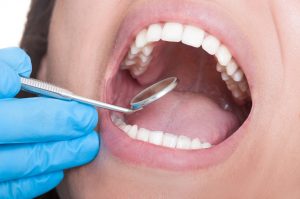 Your Sapulpa dentist performs necessary wisdom teeth extractions.