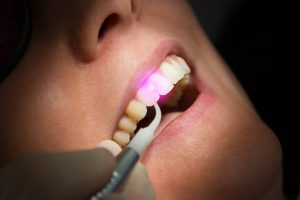 Dental laser being used on a patient’s front teeth